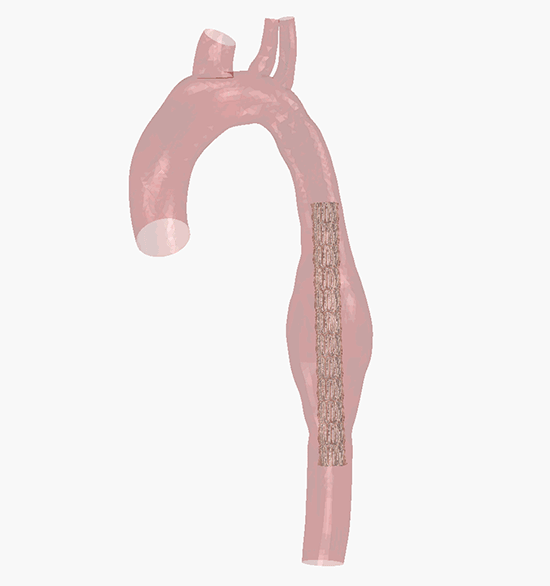 Stent deployment for a thoracic aneurysm stent graft
