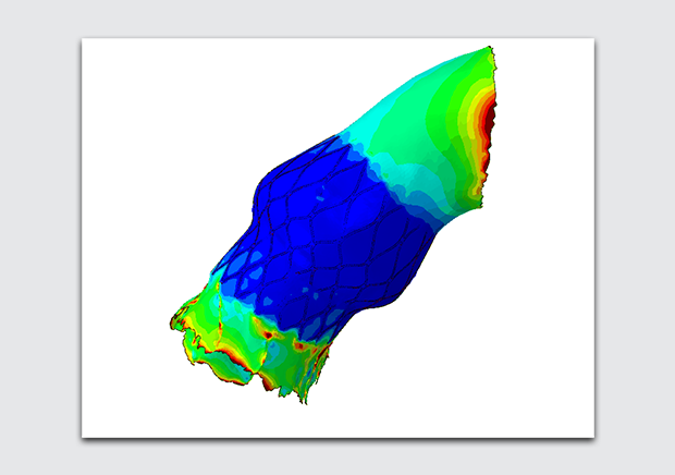AI Engine in Silico Trials: Aortic Graft Stent Demonstrator