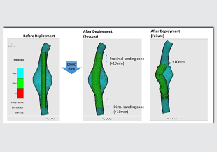 AI Engine in Silico Trials: Aortic Graft Stent Demonstrator